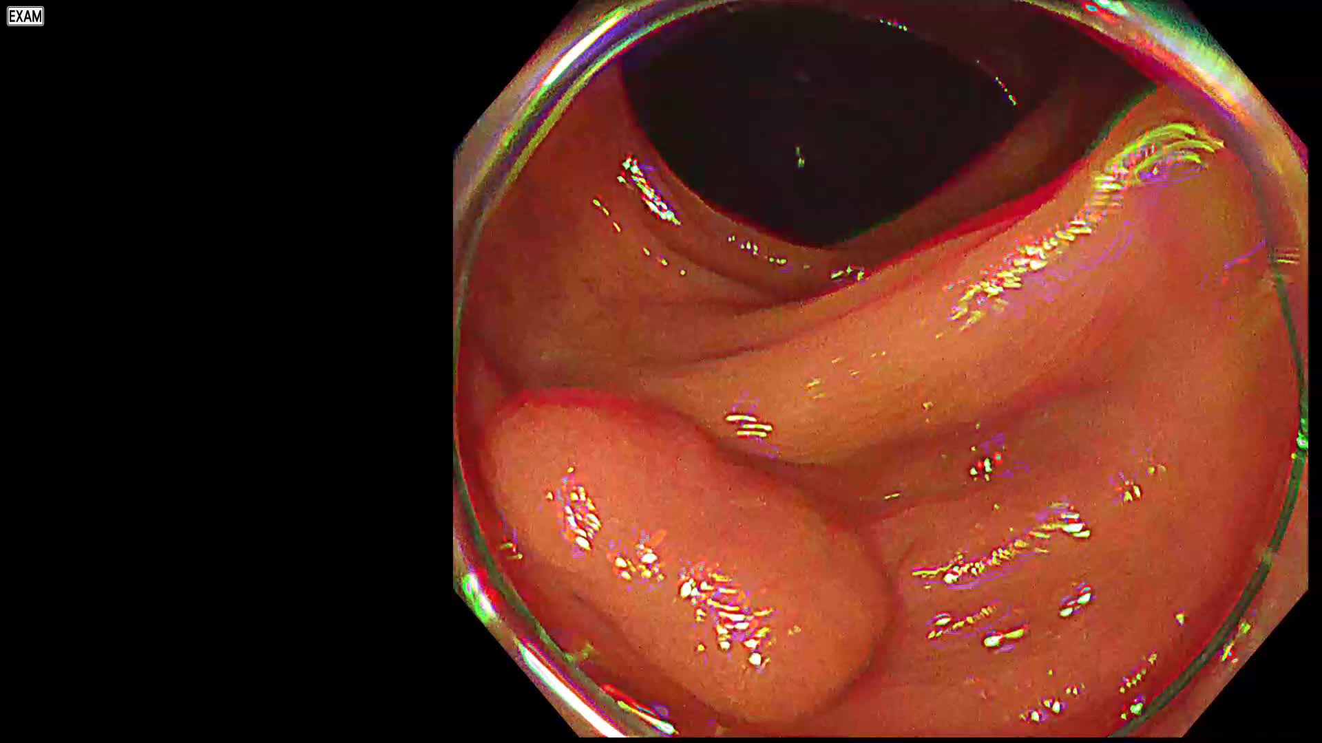 大腸腫瘍内視鏡治療の要点と盲点[WEB動画付き] (Knack & Pitfalls) 大腸腫瘍内視鏡治療の要点と盲点 | 株式会社文光堂